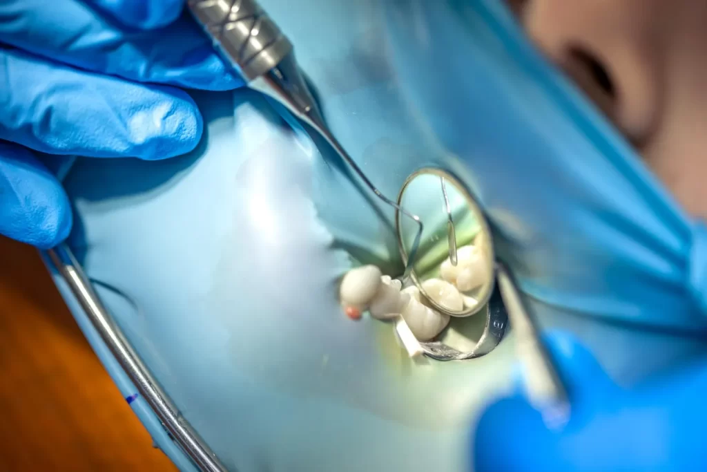 Dentist installing filling material as part of the tooth filling process.