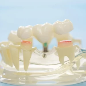 Dental bridge model showing how missing teeth are replaced as part of gap restoration treatment.