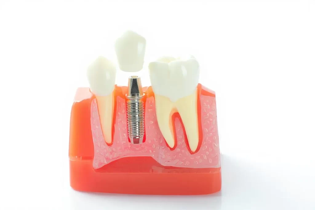 Close-up model of a dental implant showing how tooth replacement supports dental gap restoration.