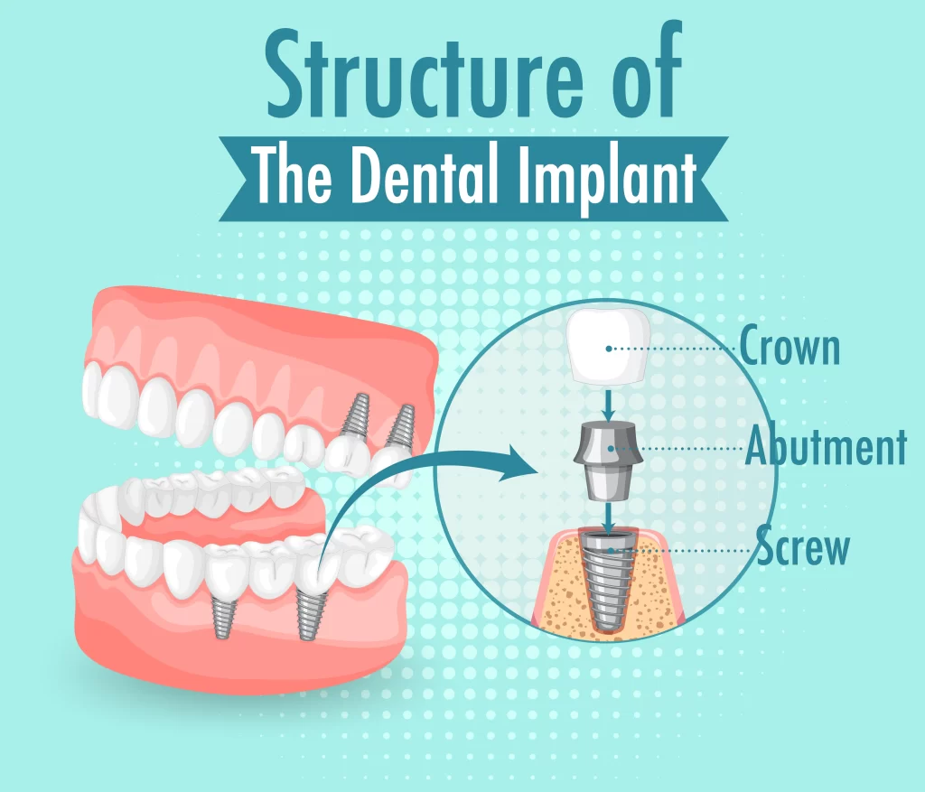 Diagram of implant structure with crown, abutment connector and screw seated in the jaw.