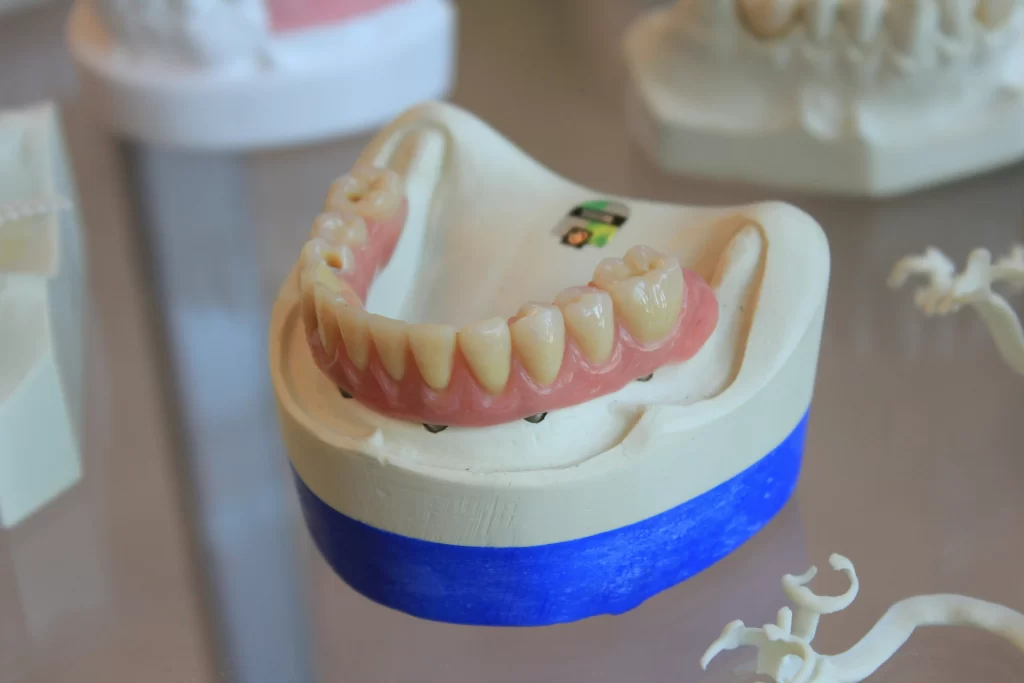 Dental jaw model showing implant posts anchored in bone supporting a fixed prosthetic arch.
