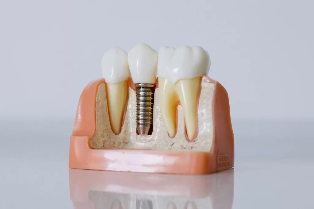 Dental model showing an implant fixture, crown and surrounding jawbone.