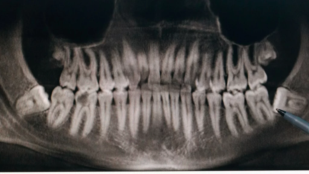 Panoramic dental X-ray showing impacted wisdom teeth at the back of the jaw.