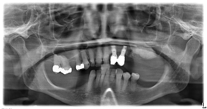 Sinus Lift